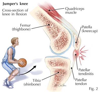 Sprains and strains 
