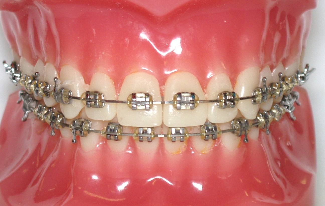 Do you need braces?