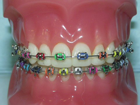 Do you need braces?