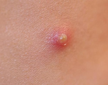 can you handle pimples?
