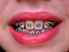 Do you need braces?