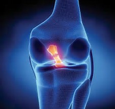 ACL Injuries