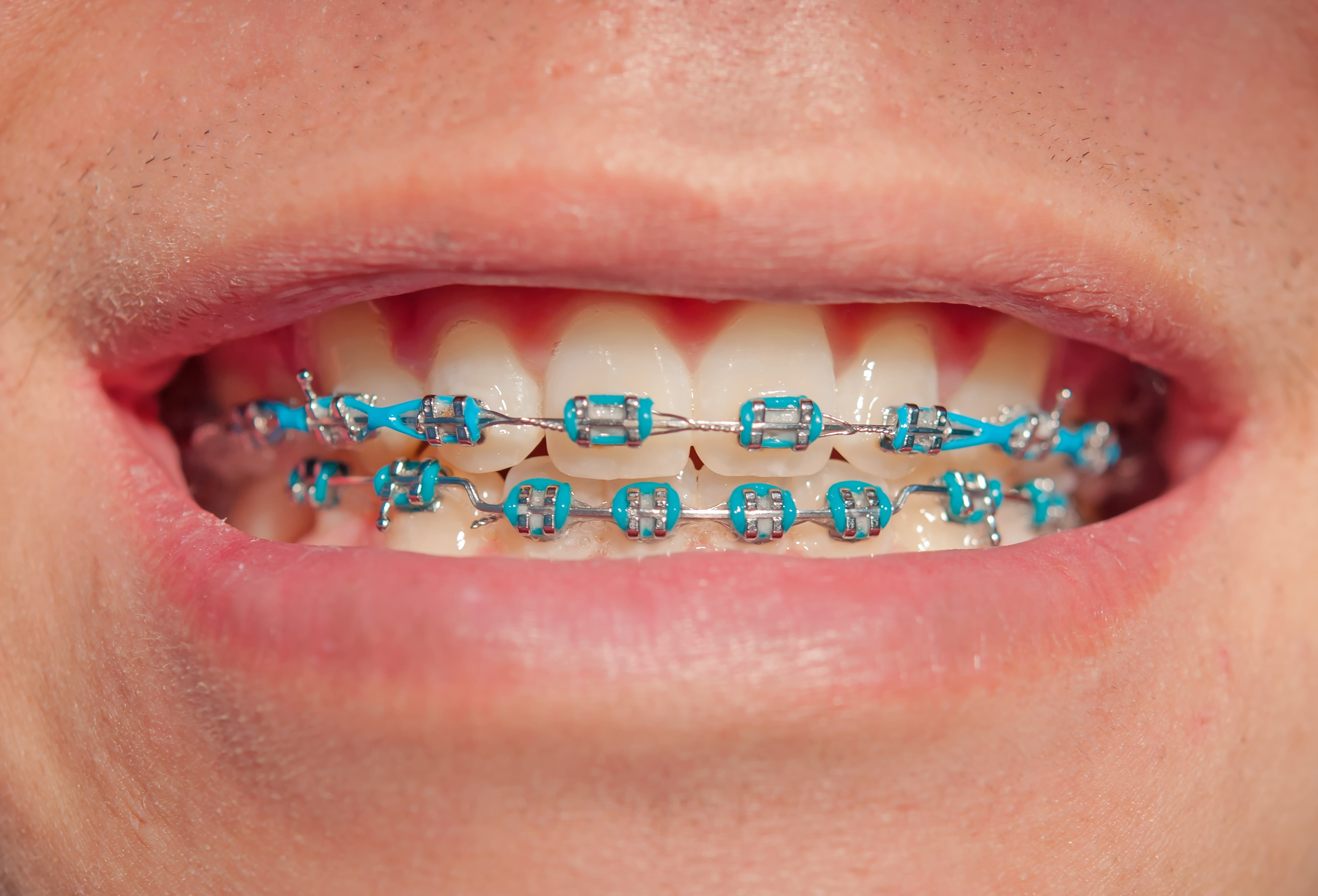 do u need braces