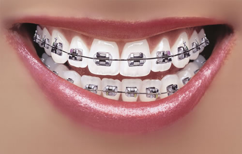 Do you Need Braces?