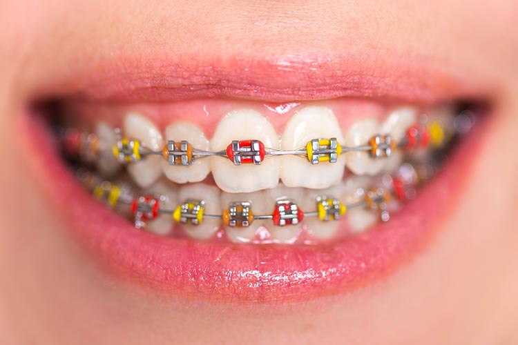 Do YOU need braces?