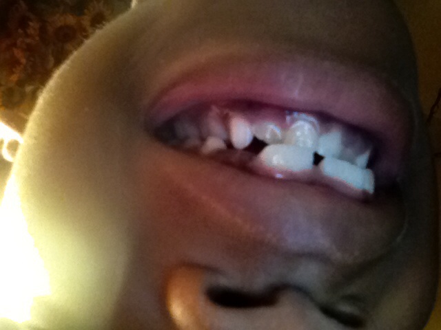 Do u have cavities
