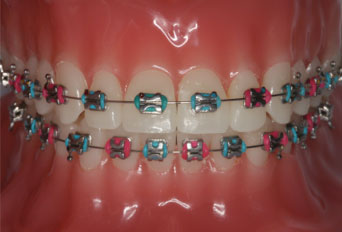 Do you need braces