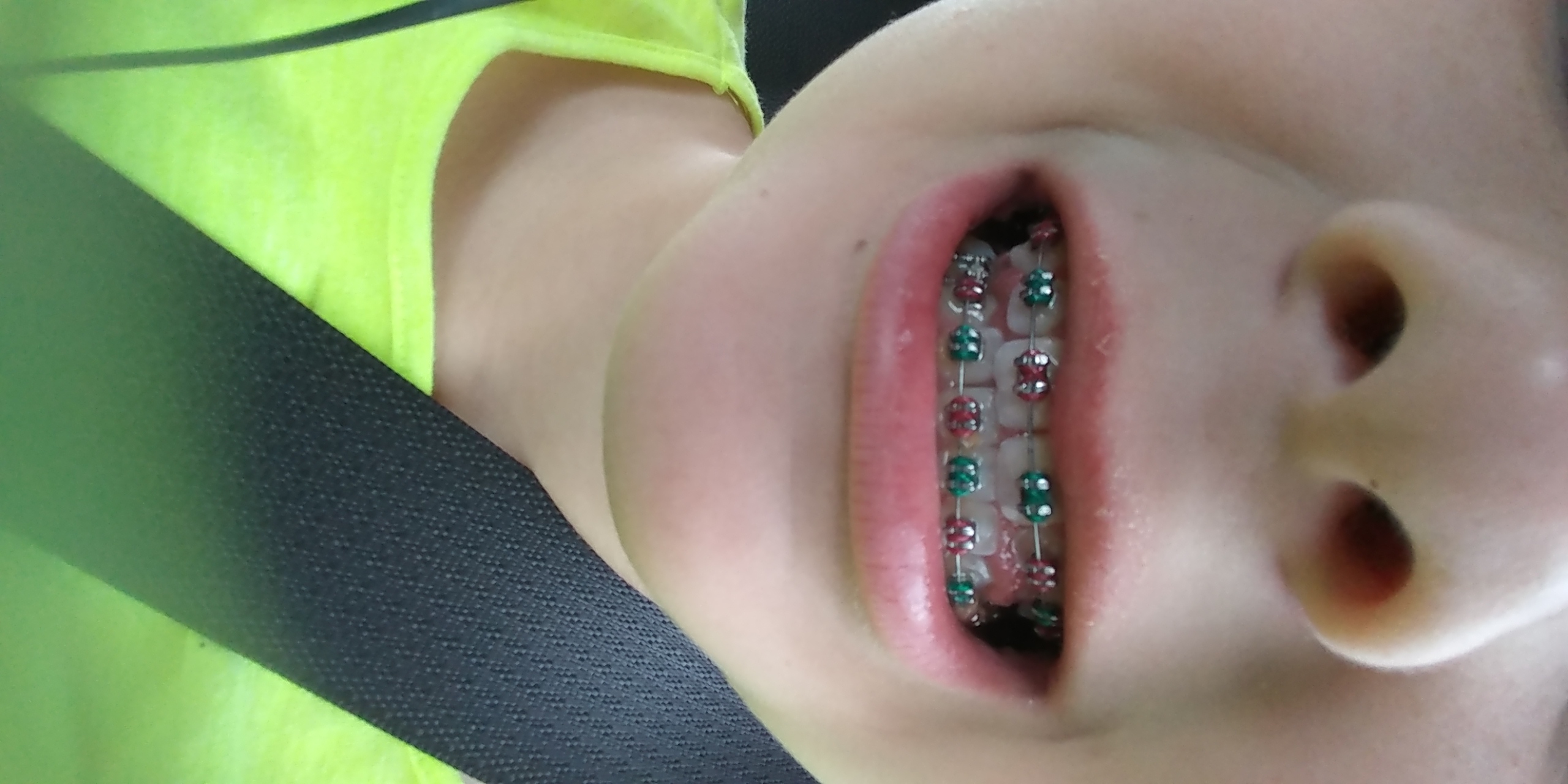 Do u need braces
