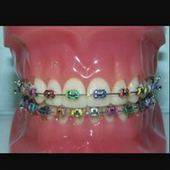 Do you need braces