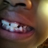 Do u have cavities
