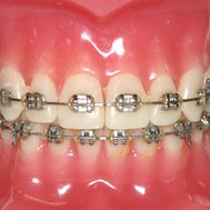 Do you need braces?
