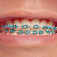 do u need braces