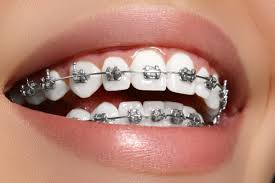 Do you need braces?