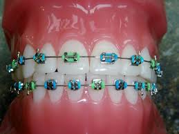 need braces