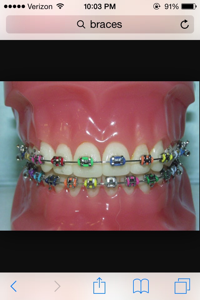 Do you need braces