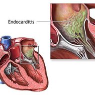 Endokarditis