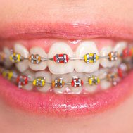 Do you need braces?